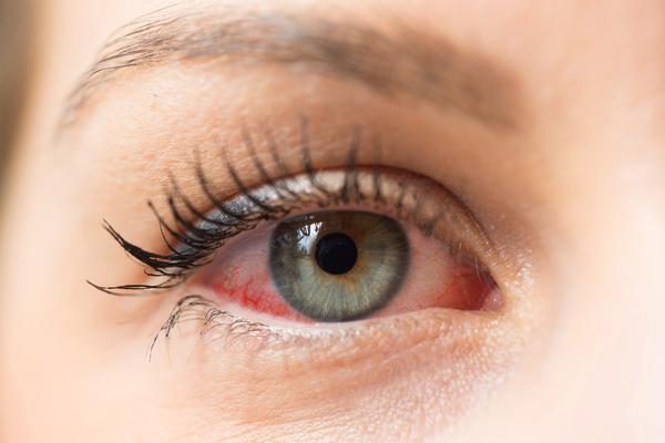  Glaucoma e olho seco: Quais os sintomas? Como tratar?