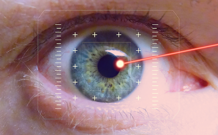  Como funciona a iridotomia a laser para o glaucoma?