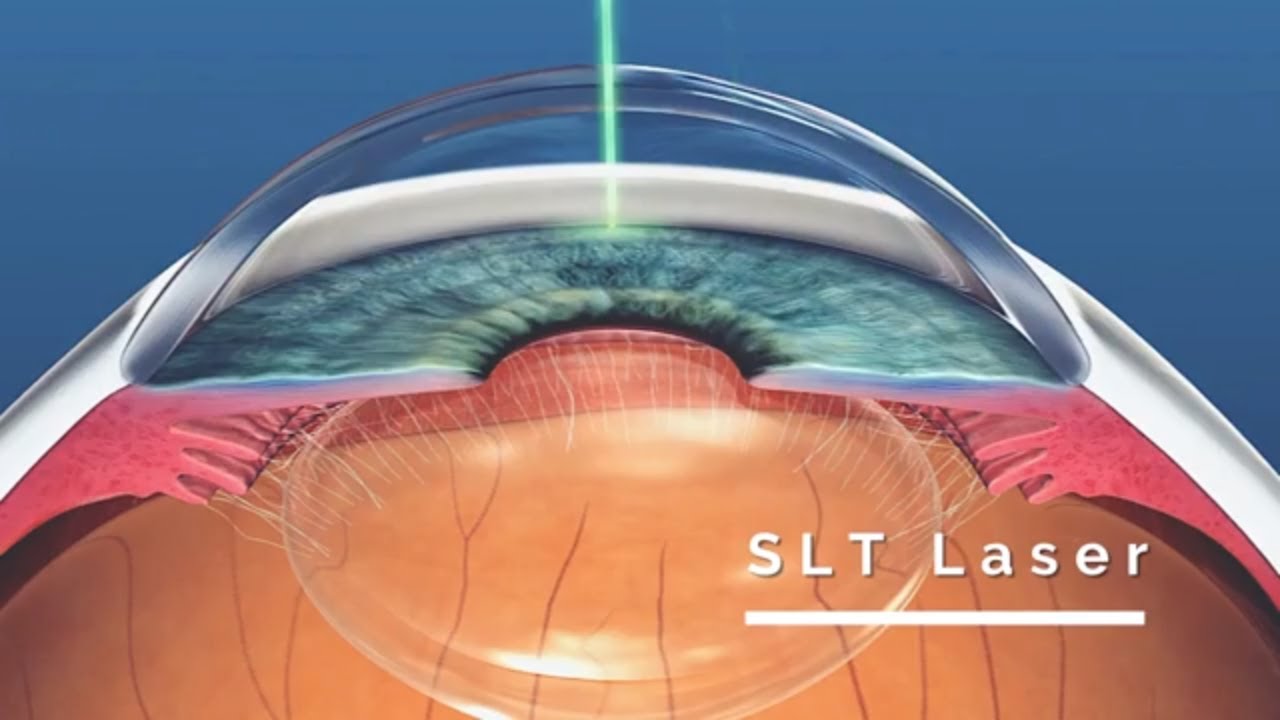 O Que Trabeculoplastia Seletiva A Laser Qual O Valor Onde Fazer 