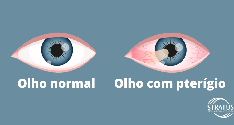  O que é pterígio? Quais os sinais? Como é o tratamento?