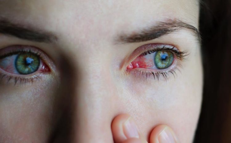  6 causas de vermelhidão ocular