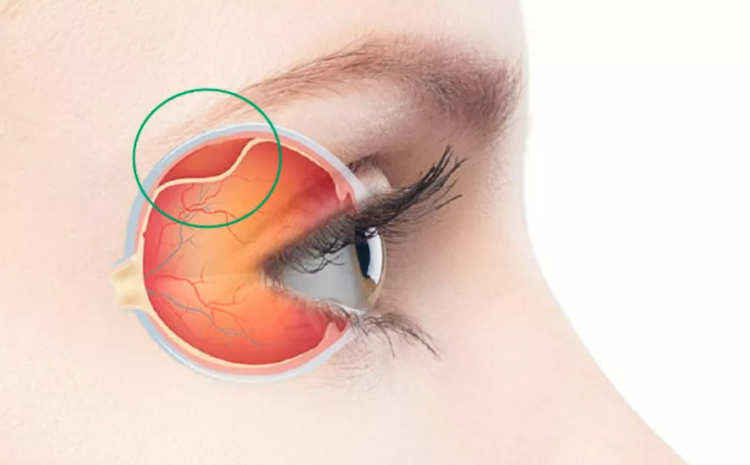  Sintomas do descolamento da retina – tudo que você precisa saber