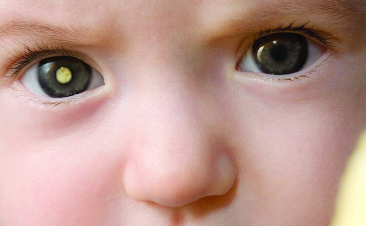  Retinoblastoma é o câncer ocular mais prevalente na infância